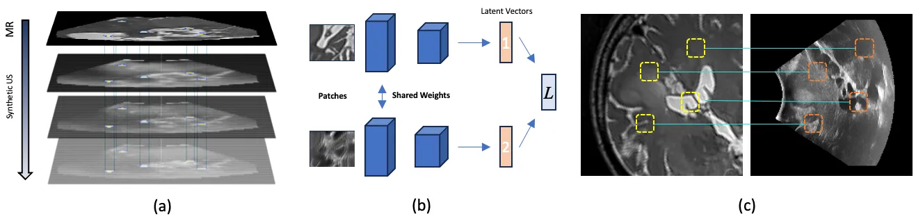 Method overview: (a) a stack of synthetic ultrasound images generated from one MRI slice, sharing the same keypoints; (b) a Siamese network with shared weights turning image patches into descriptor vectors trained with a contrastive loss; (c) keypoints on an MRI slice connected by match lines to the same points on an intraoperative ultrasound image.